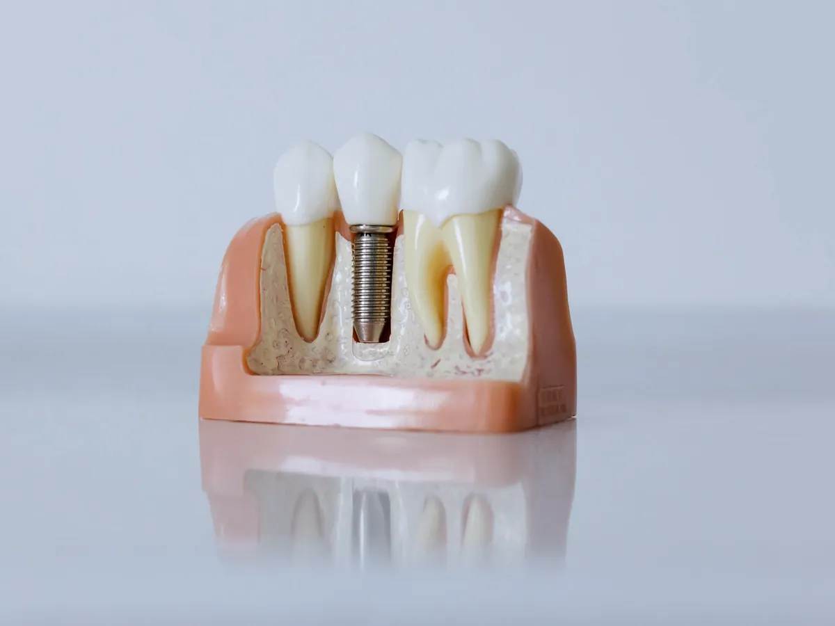 Model of a dental implant beside natural teeth